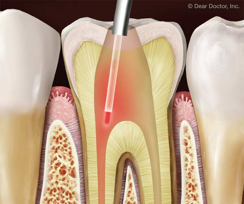 Laser-Assisted Root Canal Treatment.