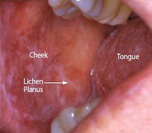 Lichen planus.