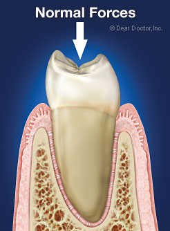 Healthy tooth with normal forces.