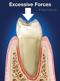 Primary Occlusal (Bite) Trauma.