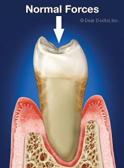 Secondary Occlusal (Bite) Trauma.