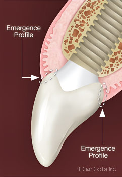 Emergence Profile