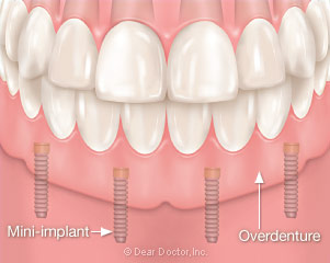 Mini-implant