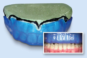 Mouthguard example