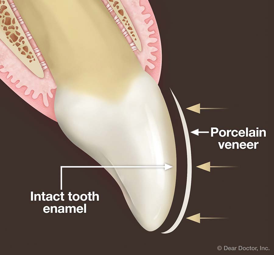 No-Prep Porcelain Veneers.