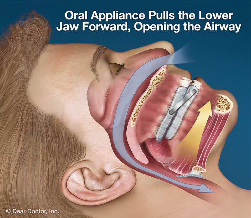 Oral Appliance For Sleep Apnea.