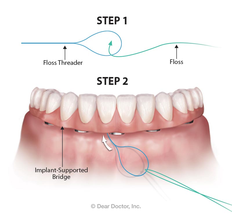 Oral Hygiene For Fixed Bridgework - Flossing Around Dental Implants-2888