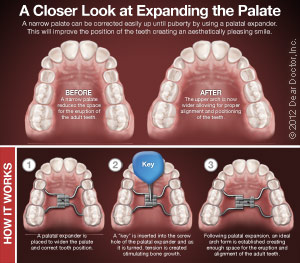 How palatal expanders work