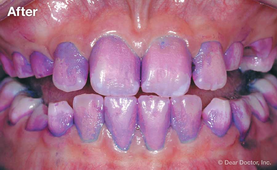 Does Food Coloring Stain Teeth? 