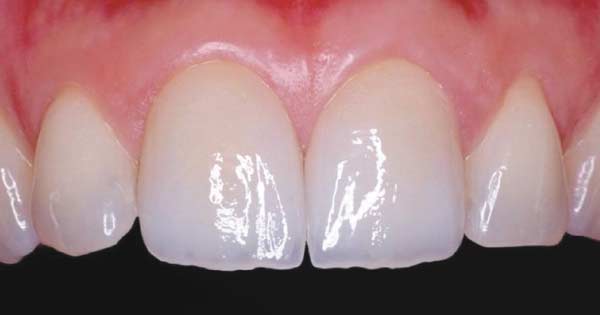 After dental crowns.