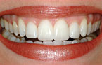 Porcelain Veneers After