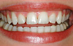 Porcelain Veneers Before