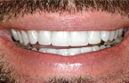 Porcelain Veneers After