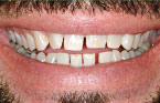 Porcelain Veneers Before