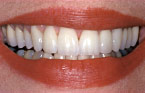 Porcelain Veneers After