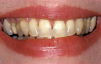 Porcelain Veneers Before