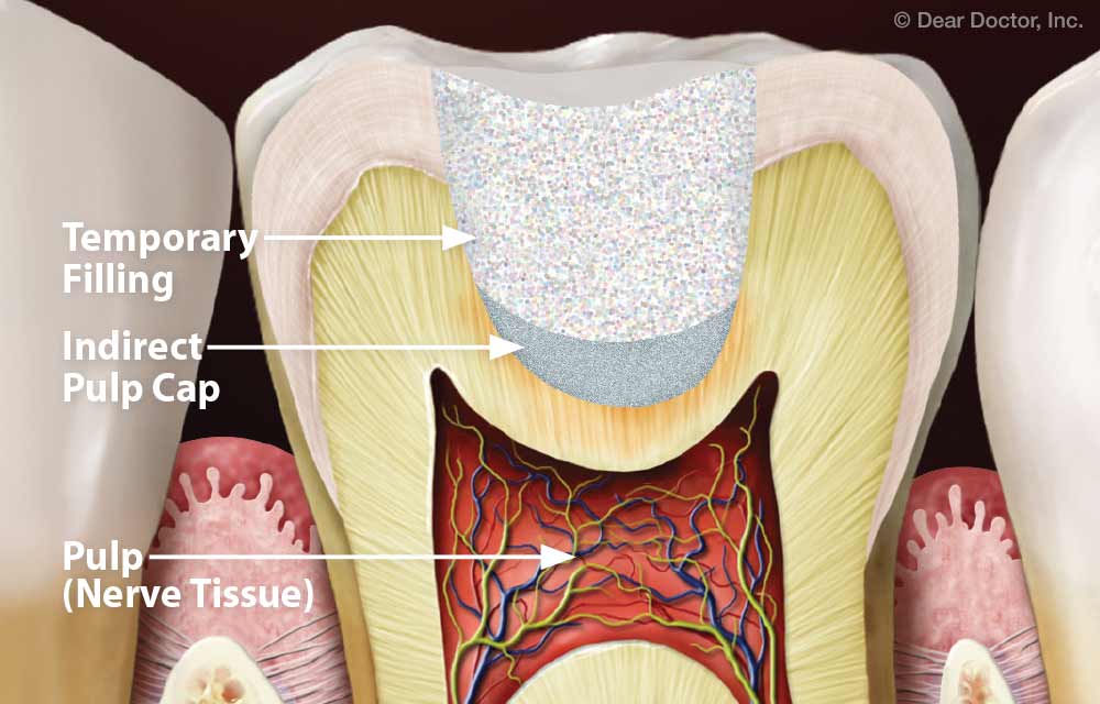 Indirect pulp cap.