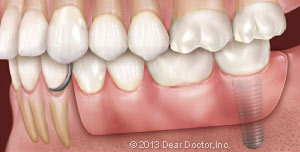 Dental implant supported removable partial denture.