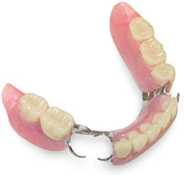 Removable partial denture