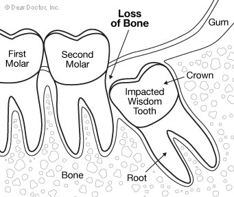 Removing wisdom teeth