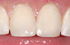 Teeth Bonding After