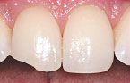 Teeth Bonding Before