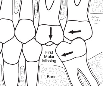 Replacing back teeth