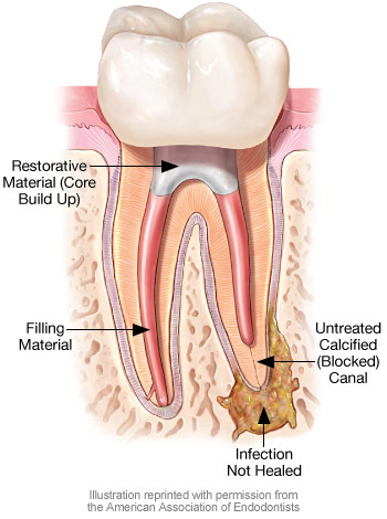 Root Canal Retreatment