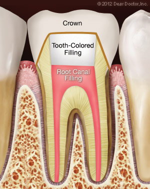 Root canal treatment.