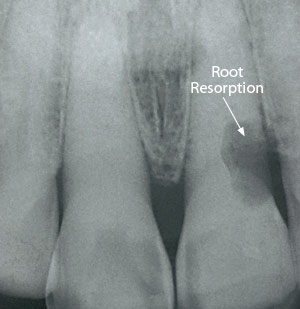 Root resorption.