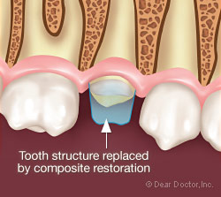 Composite restoration