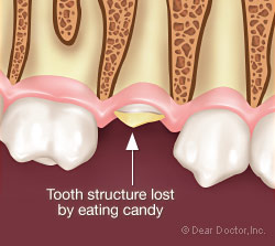 Fractured tooth