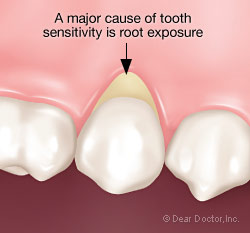 Sensitive teeth - root exposure