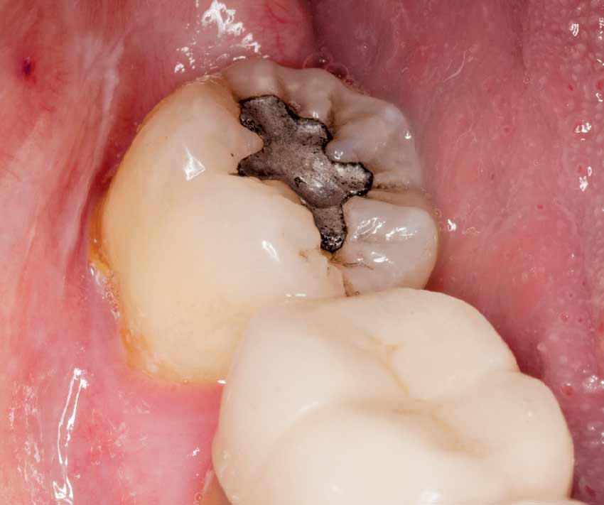 Are Metal Tooth Fillings Dangerous to Health?