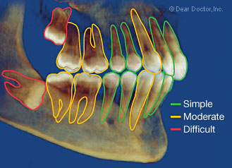 Simple tooth extraction