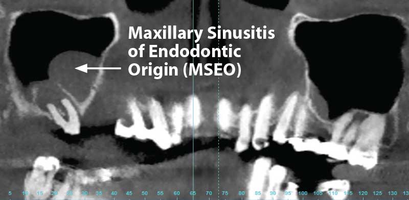 Maxillary Sinusitis of Endodontic Origin (MSEO).