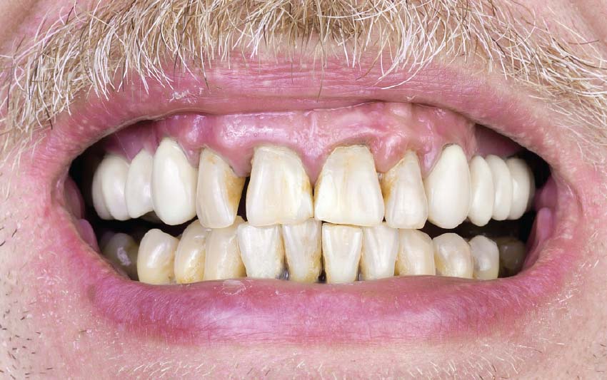 Teeth after smoking and gum disease.