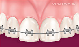 Muscle frenum braces