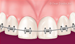 Muscle frenum braces