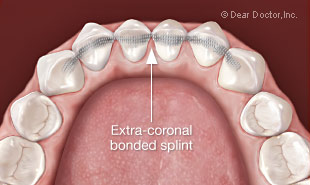 Splinting teeth