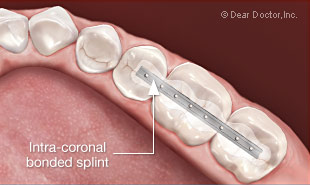 Splinting teeth