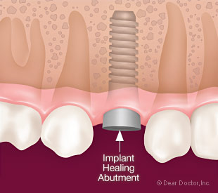 Dental implant healing abutment