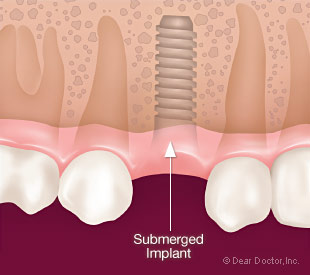 Submerged dental implant