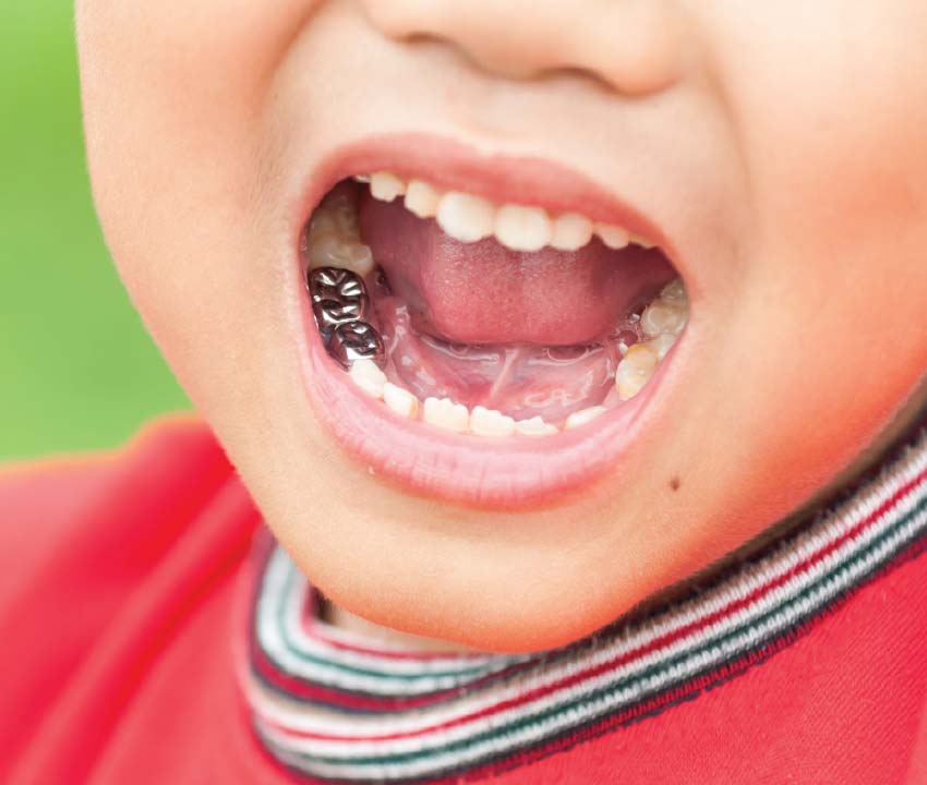 silver crown teeth