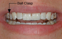 Ball clasp