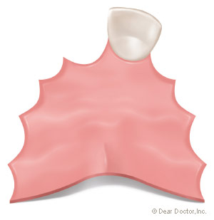 Removable partial denture illustration.