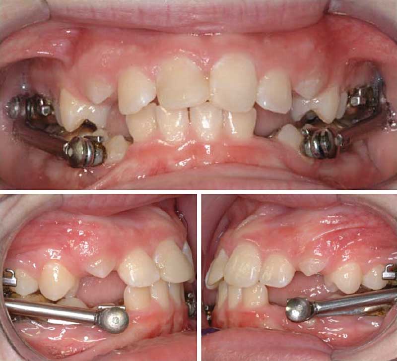 The Herbst Appliance Correcting Orthodontic Problems