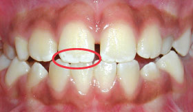 Enamel fluorosis.