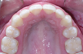 After removal of first premolars and orthodontic treatment.