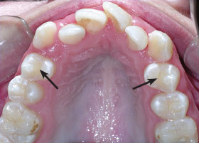 Crowded teeth requiring an extraction.
